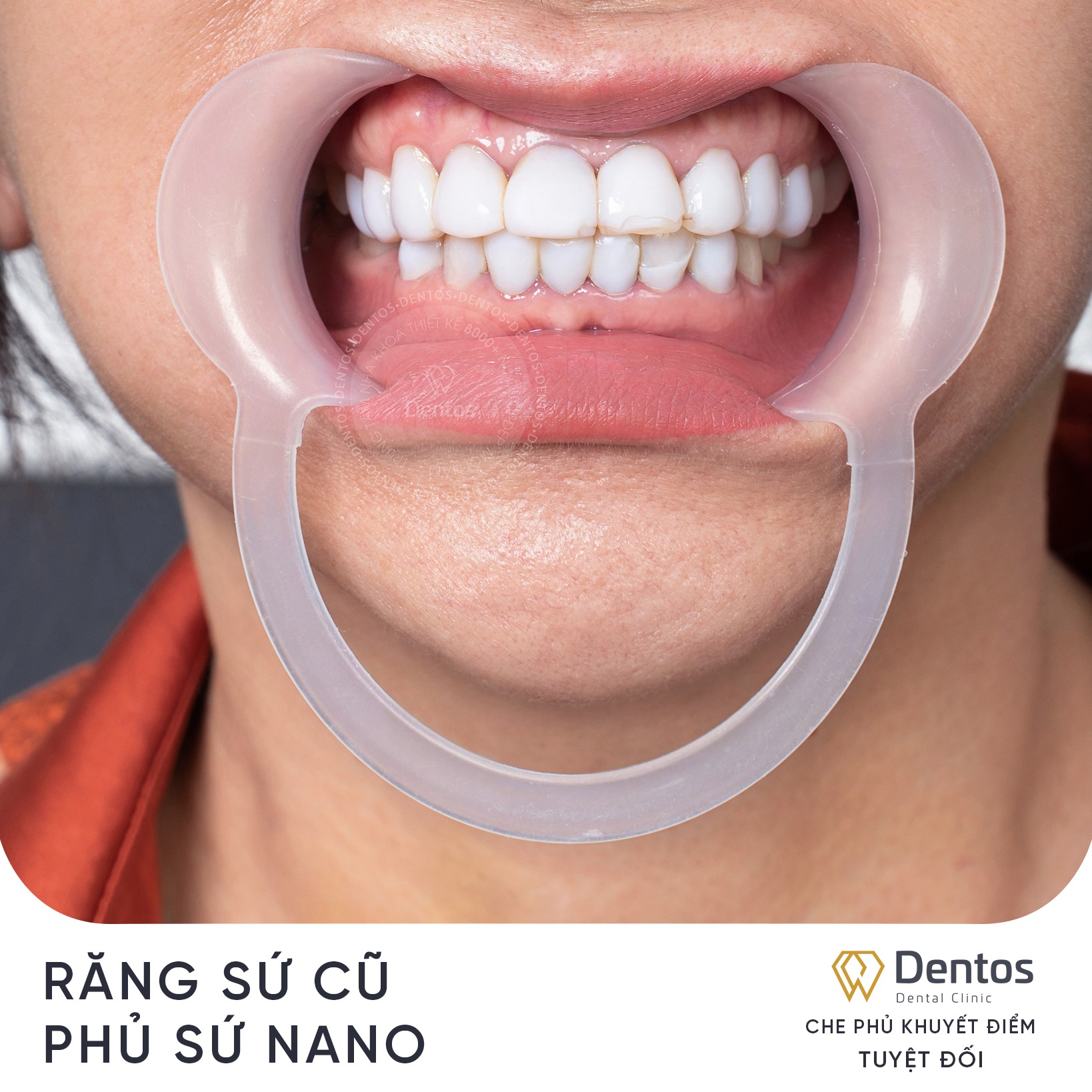 Răng phủ sứ nano dễ sứt mẻ, bể vỡ